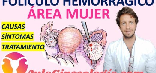 Como-manejar-el-sindrome-de-ovario-luteinizado | SoloSalud.net Cómo manejar el síndrome de ovario luteinizado