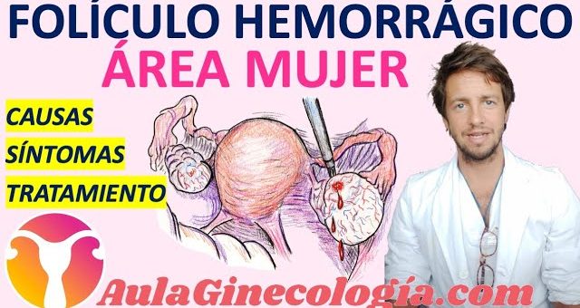 Cómo manejar el síndrome de ovario luteinizado