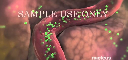 Como-manejar-el-sindrome-de-ovario-luteinizado-bilateral | SoloSalud.net Cómo manejar el síndrome de ovario luteinizado bilateral