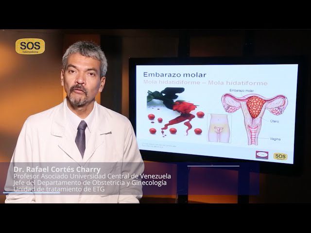 Todo sobre el seguimiento del embarazo molar