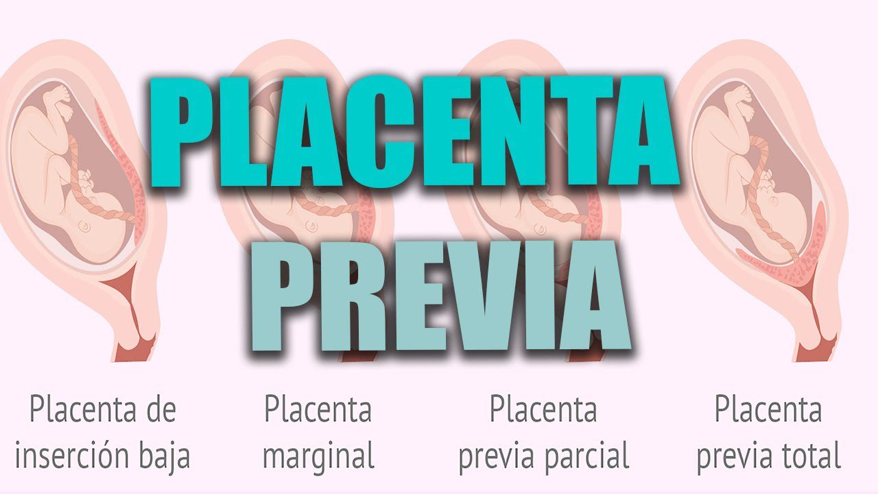 Todo sobre el seguimiento del embarazo con placenta previa