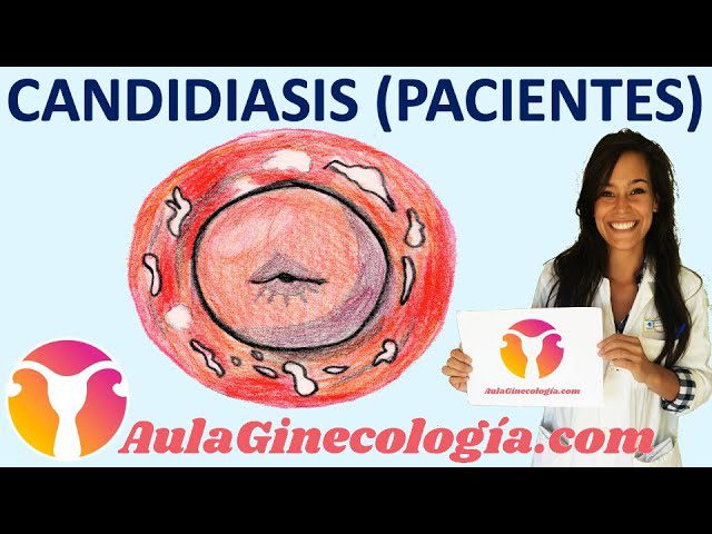 Cómo prevenir y tratar la candidiasis vaginal
