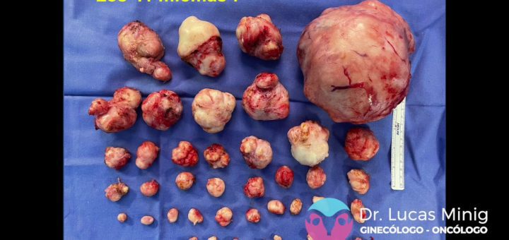 Todo lo que necesitas saber sobre la extirpación de fibromas uterinos