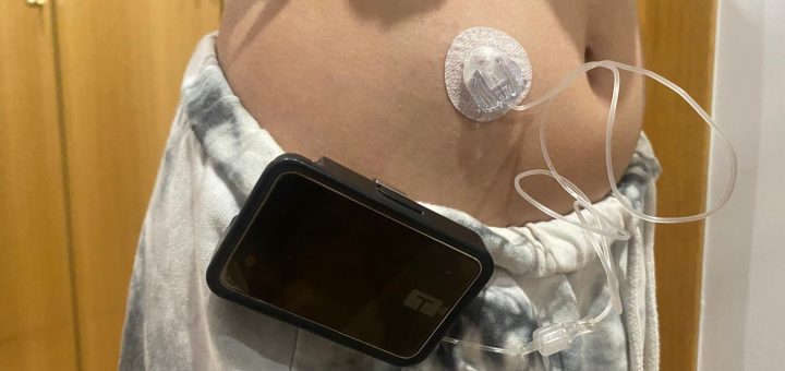 Circular medical sensor taped to the lower abdomen connected by a wire to a small black device clipped to the pants.