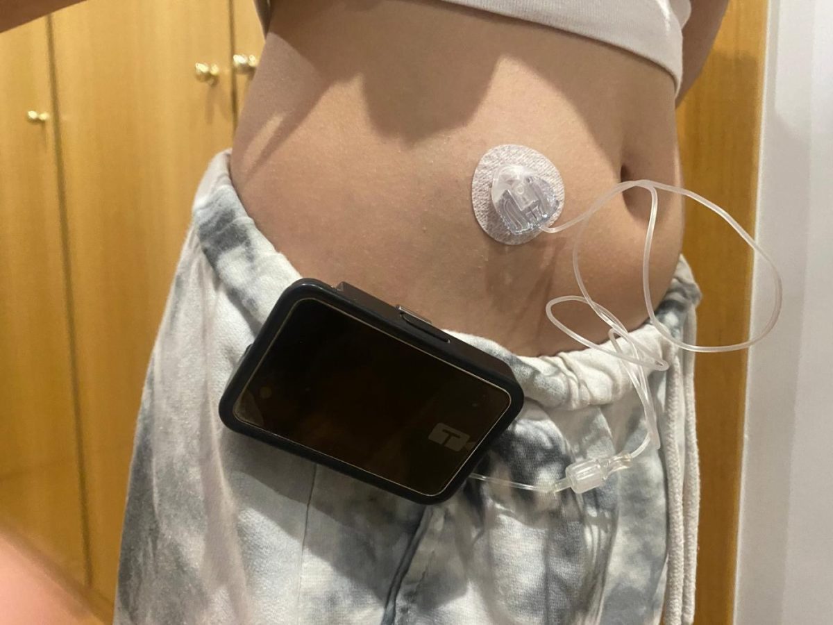 Circular medical sensor taped to the lower abdomen connected by a wire to a small black device clipped to the pants.