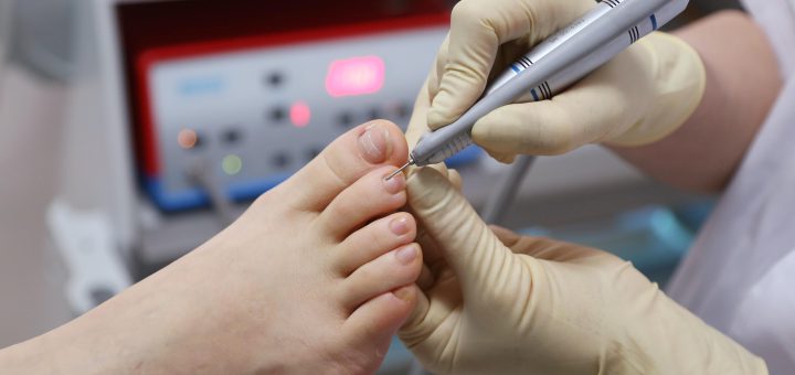 Podiatrist wearing gloves uses a nail drill on a patient’s toenail during a foot care procedure.