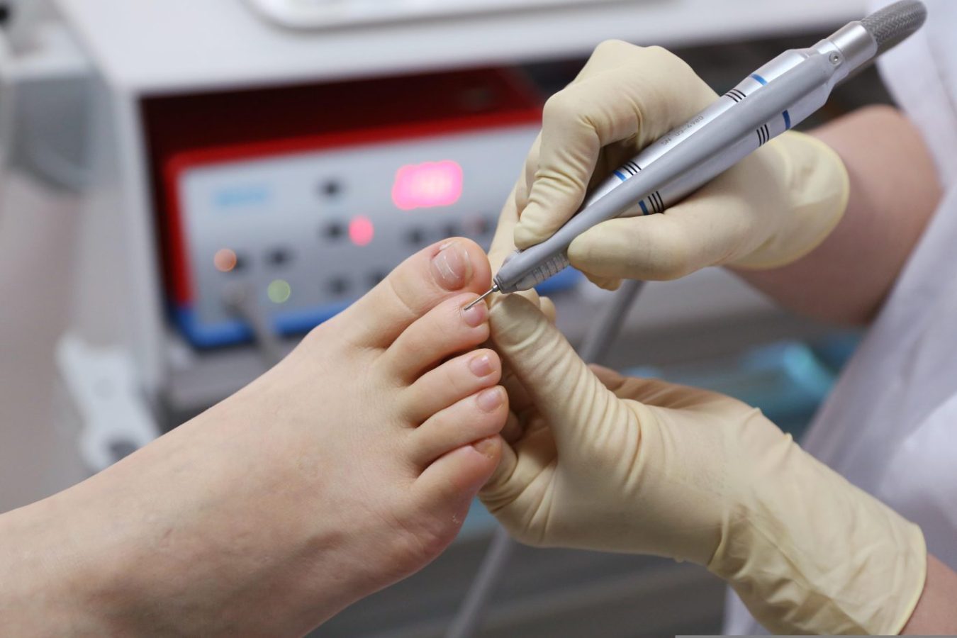 Podiatrist wearing gloves uses a nail drill on a patient’s toenail during a foot care procedure.
