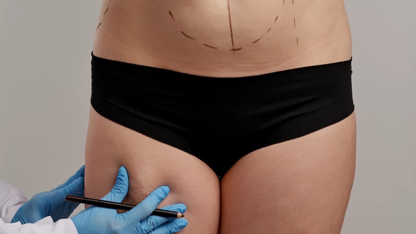 Patient standing in black underwear with surgical markings on the abdomen and upper legs; clinician wearing blue gloves marks the area with a marker for a cosmetic procedure.