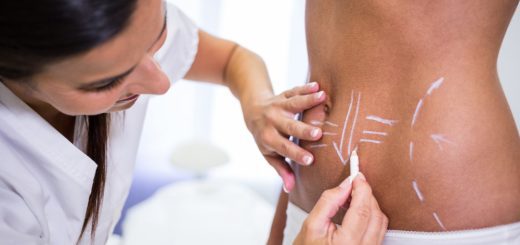 Clinician marks a patient's lower back with chalk lines for a cosmetic procedure planning.