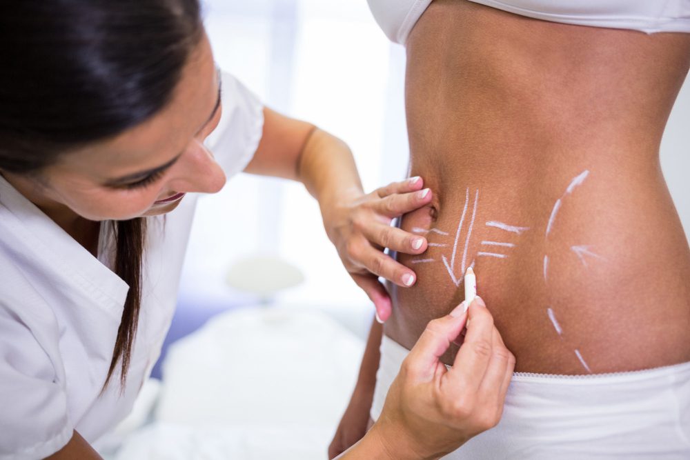 776269 - Etérea Fisioestética | SoloSalud.net Clinician marks a patient's lower back with chalk lines for a cosmetic procedure planning.